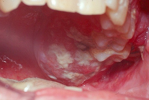 Hình ảnh ung thư miệng được thể hiện rõ trong bài viết này