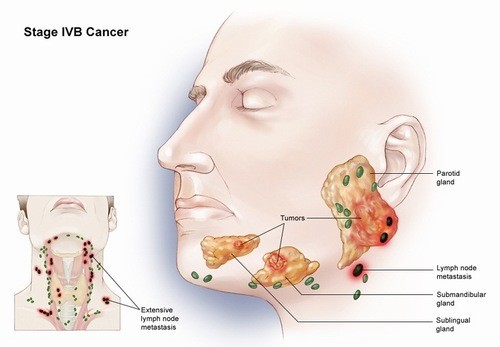 Hình ảnh ung thư tuyến nước bọt