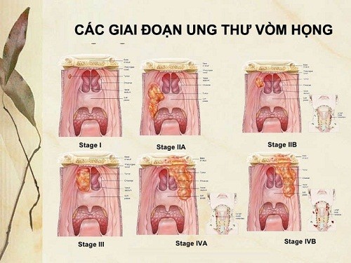 Hình ảnh ung thư vòm họng qua các giai đoạn phát triển
