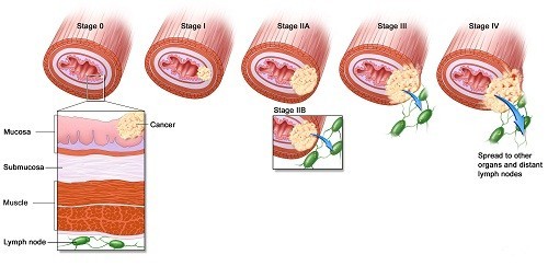 Hình ảnh ung thư vòm họng qua các giai đoạn