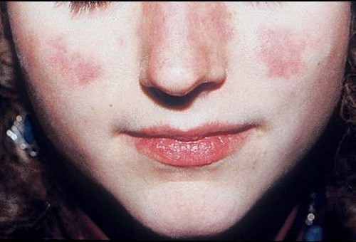 Lupus ban đỏ hệ thống là bệnh tự miễn bởi các rối loạn ở hệ thống miễn dịch.