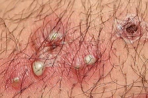 Mọc mụn bọc ở vùng kín khiến người bệnh cảm thấy ngứa ngáy, đau đớn, khó chịu
