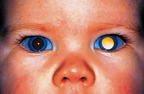 Sự bất thường ở nhiễm sắc thể 13 cũng là yếu tố gây ung thư mắt