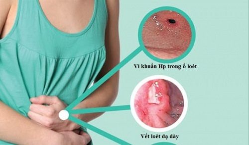 Có nhiều nguyên nhân gây viêm loét dạ dày tá tràng như nhiễm vi khuẩn HP, căng thẳng thần kinh...