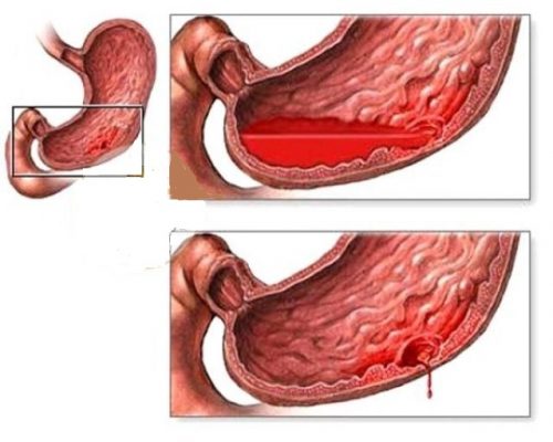 Xuất huyết dạ dày là bệnh đường tiêu hóa nguy hiểm có thể đe dọa đến tính mạng của người bệnh và gây ra rất nhiều biến chứng nguy hiểm khác. 
