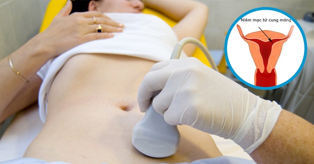 Nội mạc tử cung mỏng chỉ được xác định chính xác thông qua kết quả siêu âm