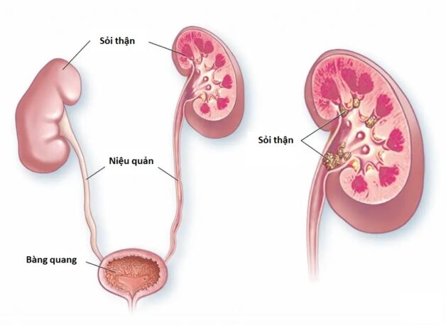 Điều trị sỏi tiết niệu như thế nào? hiệu quả nhanh chóng