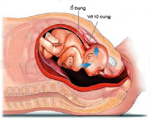 Điều Trị Chửa Ngoài Tử Cung