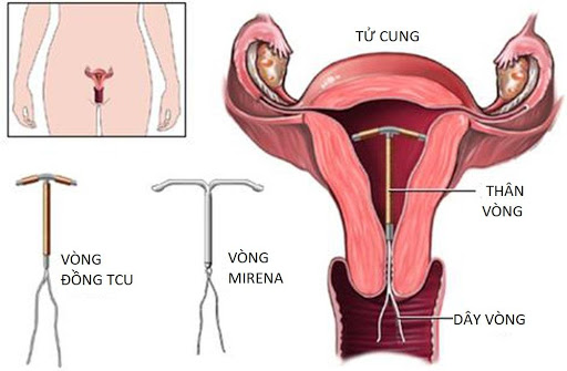 hãy chờ khoảng 2, 3 tháng sau khi đã tháo vòng để tử cung ổn định rồi mới có em bé
