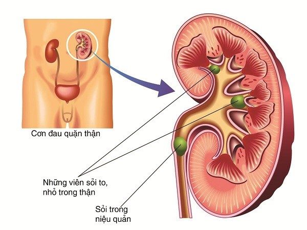 Triệu Chứng Sỏi Thận - Tiết Niệu