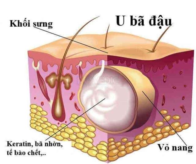U bã đậu là một dạng u lành tính, có cấu tạo bởi lớp vỏ bọc, bên trong là chất bã mềm, màu vàng nhạt hoặc vàng đục....
