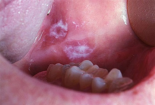 Khi bị ung thư miệng, người bệnh sẽ thấy vết loét trong miệng lâu lành