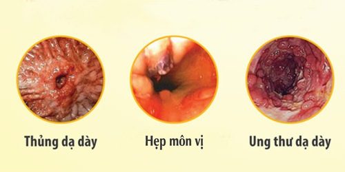 Viêm dạ dày cấp tính nếu không được điều trị sớm có thể gây nhiều biến chứng nguy hiểm