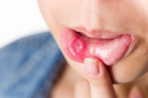 Biểu hiện bệnh giang mai ở miệng
