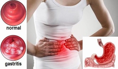 Khi thấy xuất hiện những triệu chứng nghi ngờ mắc bệnh lý ở dạ dày, người bệnh cần tiến hành nội soi để xác định bệnh
