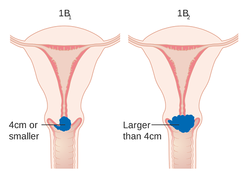 Hình ảnh ung thư cổ tử cung giai đoạn đầu | TCI Hospital