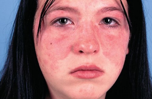 Bệnh Lupus ban đỏ có thể do nhóm vi khuẩn cầu chuỗi A xâm nhập vào cơ thể và tạo ra chất độc ảnh hưởng đến bề mặt của da, gây nên tình trang phát ban màu đỏ