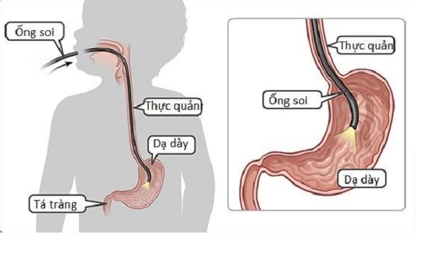 nội soi dạ dày cho trẻ em phát hiện bệnh