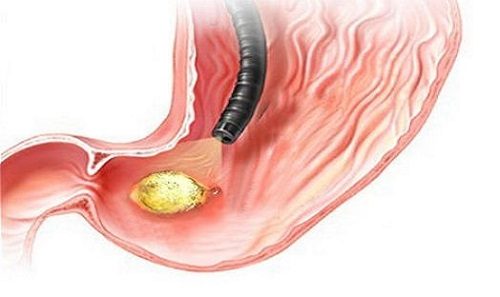 Nội soi dạ dày là một phương pháp thăm khám toàn bộ bên trong dạ dày giúp phát hiện sớm và chính xác các bệnh lý ở dạ dày.