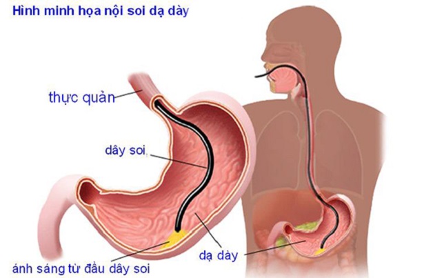 Nội soi nhiều lần có tốt không