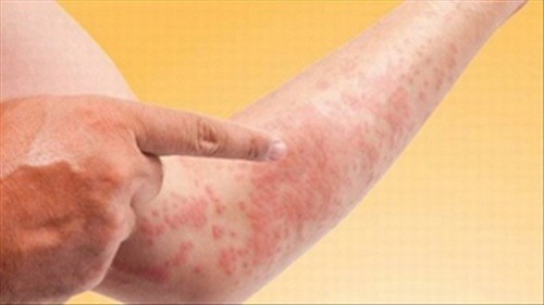 Phát ban đỏ trên da có thể do dị ứng côn trùng