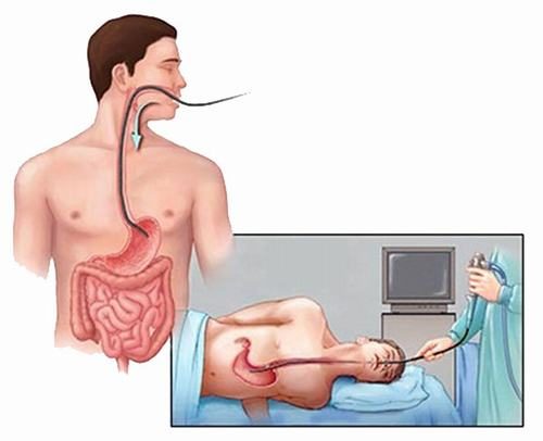 Thực hiện nội soi dạ dày mất bao lâu là băn khoăn chung của nhiều người