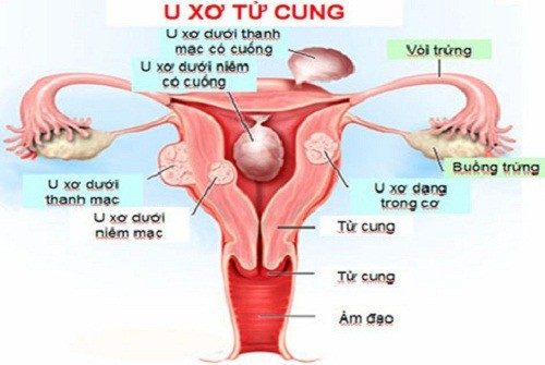 U xơ tử cung có lây không