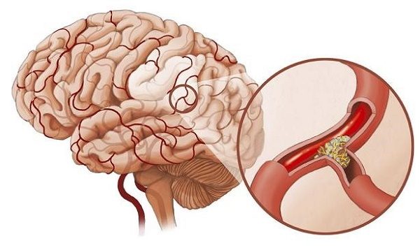 2. Phương Pháp Điều Trị Xuất Huyết Não Ở Trẻ Sơ Sinh