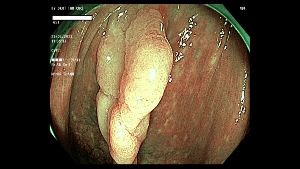 Polyp đại tràng là gì?
