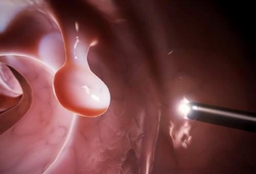Người có tiền sử polyp dạ dày cũng có nguy cơ cao mắc ung thư dạ dày
