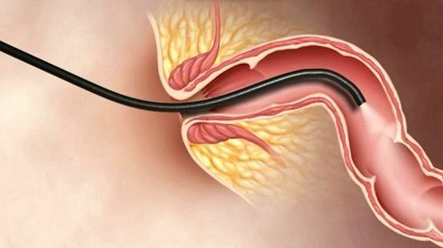Nội soi đại tràng là phương pháp sử dụng ống nội soi mềm được luồn qua hậu môn vào cơ thể giúp phát hiện sớm các bệnh lý ở đại tràng