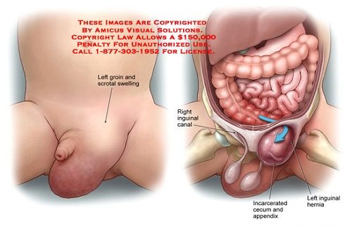 Chăm sóc trẻ sau phẫu thuật thoát vị bẹn như thế nào không phải bậc cha mẹ nào cũng biết