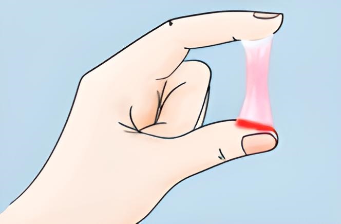 Khi dịch âm đạo có lẫn một ít sợi máu có thể là dấu hiệu của vấn đề sức khỏe nghiêm trọng