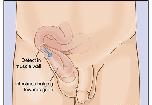 Thoát vị bẹn có thể là do bẩm sinh hoặc mắc phải