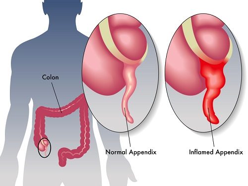 Viêm ruột thừa là bệnh phổ biến có thể gặp phải ở mọi đối tượng, lứa tuổi