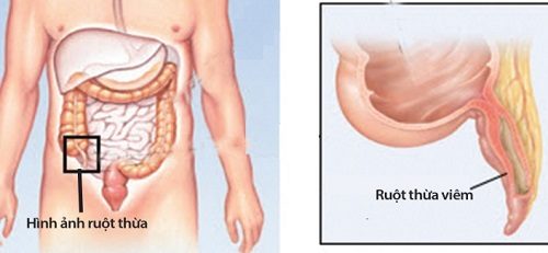 Viêm ruột thừa là tình trạng sưng và nhiễm trùng của ruột thừa.