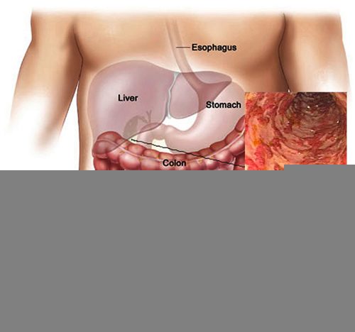 Viêm đại tràng là tình trạng đại tràng có các tổn thương hoặc bị viêm loét.
