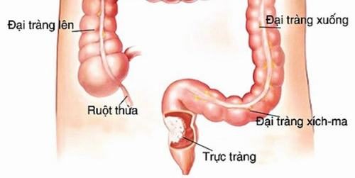 Viêm trực tràng là những tổn thương ở phần cuối của ống tiêu hóa, do nhiều nguyên nhân khác nhau gây ra
