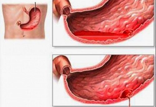 Xuất huyết dạ dày là biến chứng nguy hiểm của viêm loét dạ dày không được điều trị kịp thời và triệt để