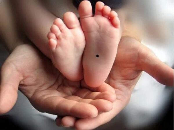 Nốt ruồi có thể là bệnh ung thư