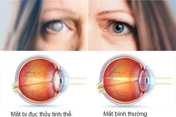 Đục thủy tinh thể sẽ khiến mắt mờ dần, không gây đau nhức, đeo kính không cải thiện được thị lực, là một trong 5 bệnh về mắt thường gặp ở người già