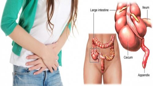 Người bệnh đau ruột thừa còn có triệu chứng đại tiện nhiều lần, tiểu khó khi mắc bệnh