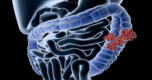 Bệnh Crohn là một bệnh viêm tại đường ruột, gây loét thành trong của ruột non và ruột già