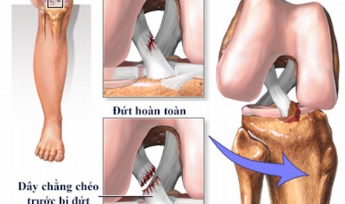 Đứt dây chằng chéo trước cần được phát hiện và điều trị hiệu quả