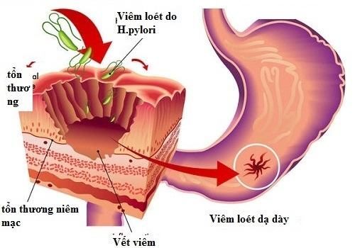 nguyên nhân chính xác gây ung thư dạ dày vẫn chưa được kết luận cụ thể nhưng có một vài yếu tố được cho là căn nguyên gây bệnh như vi khuẩn HP.