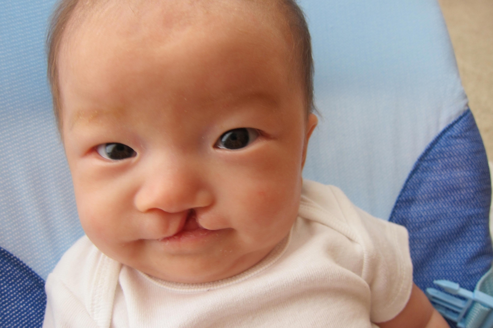 Hiện tượng sứt môi do nhiều nguyên nhân gây nên trong đó yếu tố di truyền ít được nhắc đến