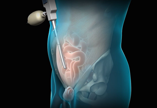 Khi bị thoát vị bẹn thì phẫu thuật bằng phương pháp nội soi được nhiều người lựa chọn. 