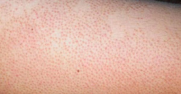  Viêm lỗ chân lông là tình trạng nhiễm trùng của các nang lông.