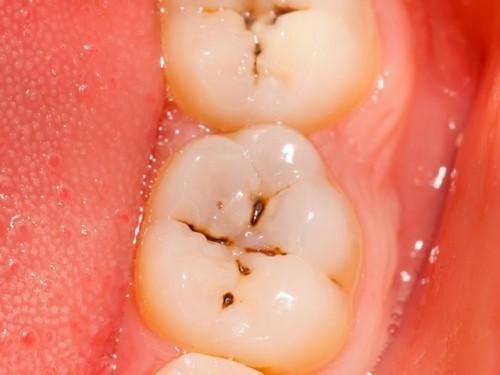 Sâu răng là bệnh lý phổ biến, có thể gặp ở mọi lứa tuổi