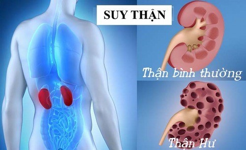 Các giai đoạn suy thận và đặc điểm của suy thận độ 3